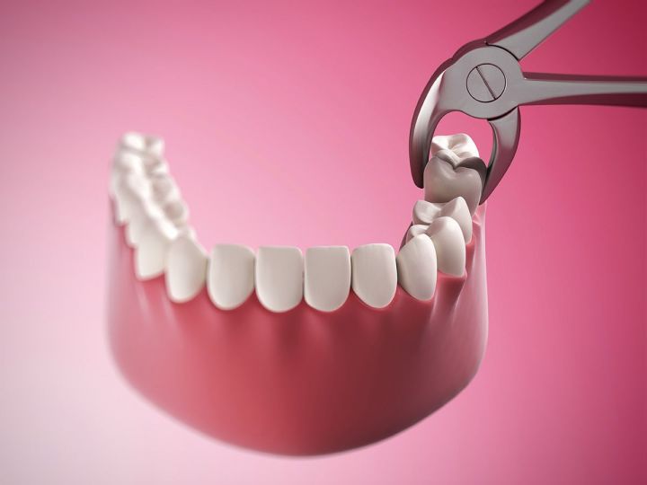 Сколько зубов можно удалять за один раз?